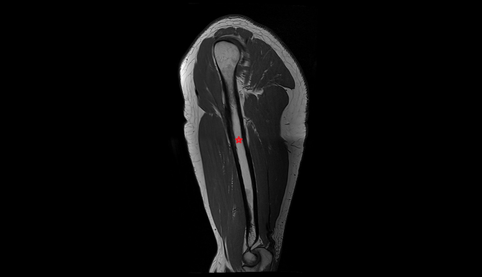 shaft of humerus mri sag image