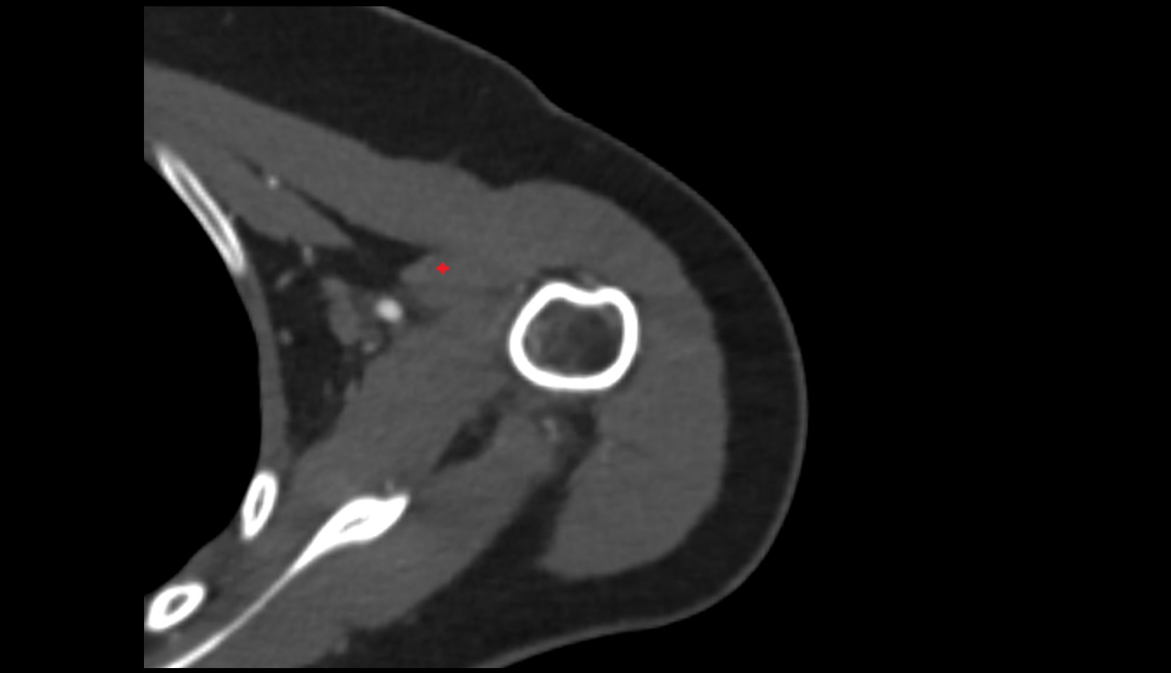 short head of biceps brachii muscle CT axial