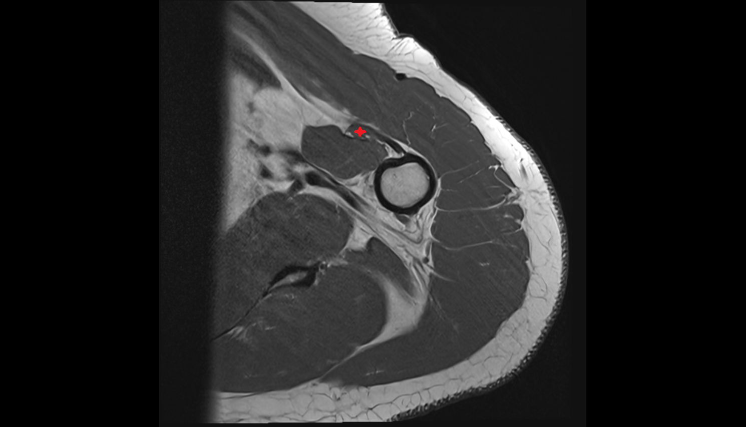 short head of biceps brachii muscle  axial cross sectional anatomy 3T MRI AI enhanced radiology image-img-00000-00000_00001
