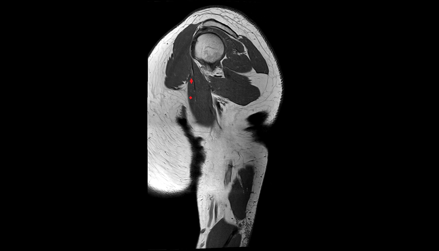 short head of biceps brachii muscle  sag cross sectional anatomy 3T MRI AI enhanced radiology image-img-00000-00000