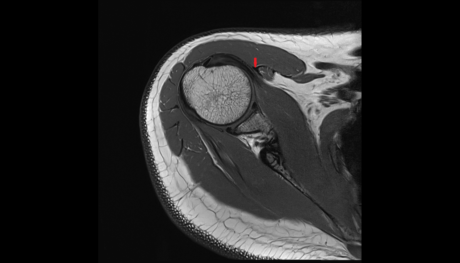 short head of the biceps brachii tendon axial cross sectional anatomy 3T MRI AI enhanced radiology image-img-00000-00000