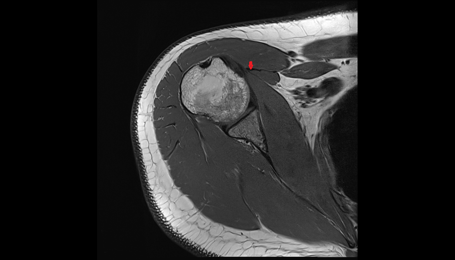 short head of the biceps brachii tendon axial cross sectional anatomy 3T MRI AI enhanced radiology image-img-00000-00000_00001
