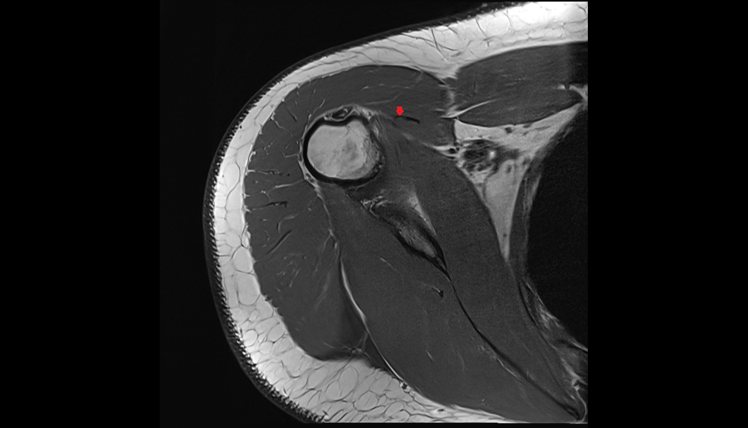 short head of the biceps brachii tendon axial cross sectional anatomy 3T MRI AI enhanced radiology image-img-00000-00000_00002