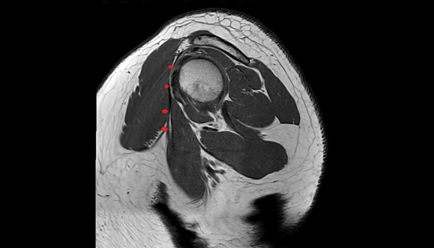 short head of the biceps brachii tendon axial cross sectional anatomy 3T MRI AI enhanced radiology image-img-00000-00000_00003