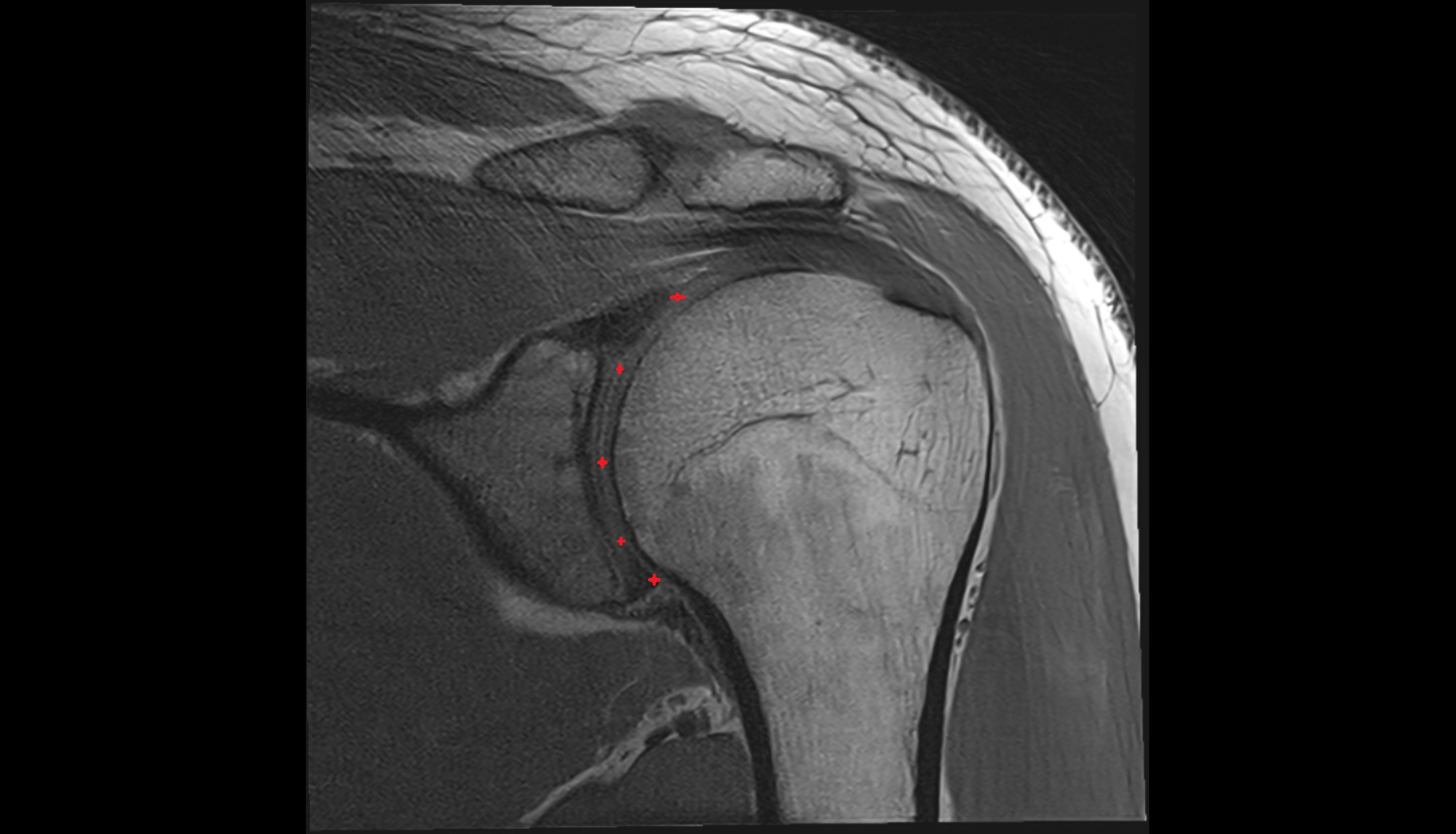 shoulder joint (glenohumeral joint) coronal cross sectional anatomy 3T MRI AI enhanced radiology image-img-00000-00000