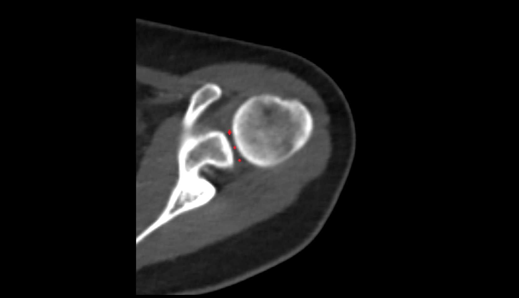 shoulder joint (glenohumeral joint) ct axial image