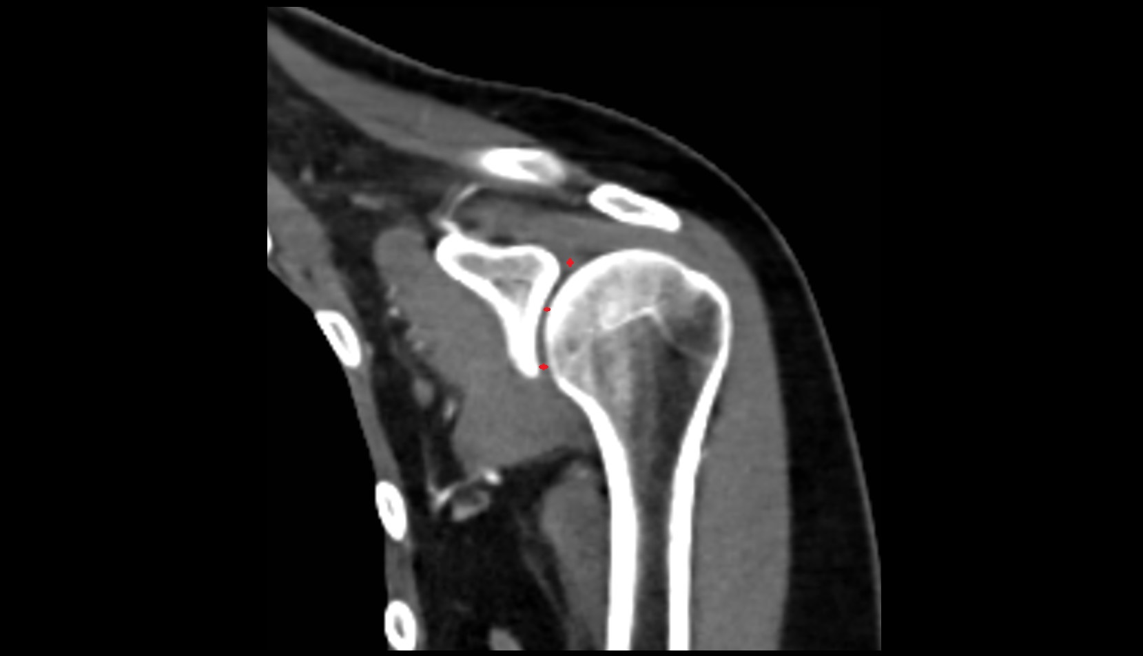 shoulder joint (glenohumeral joint) ct coronal image
