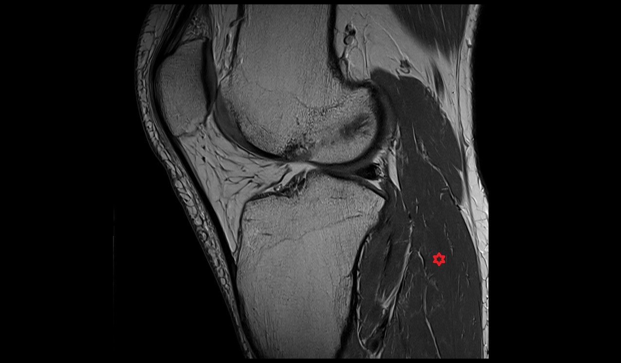 soleus muscle anatomy image 3T MRI