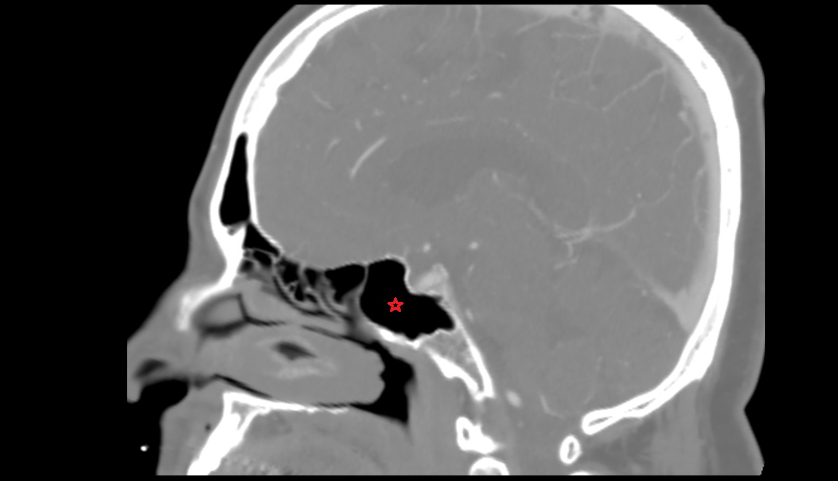 sphenoid sinus CT sag image