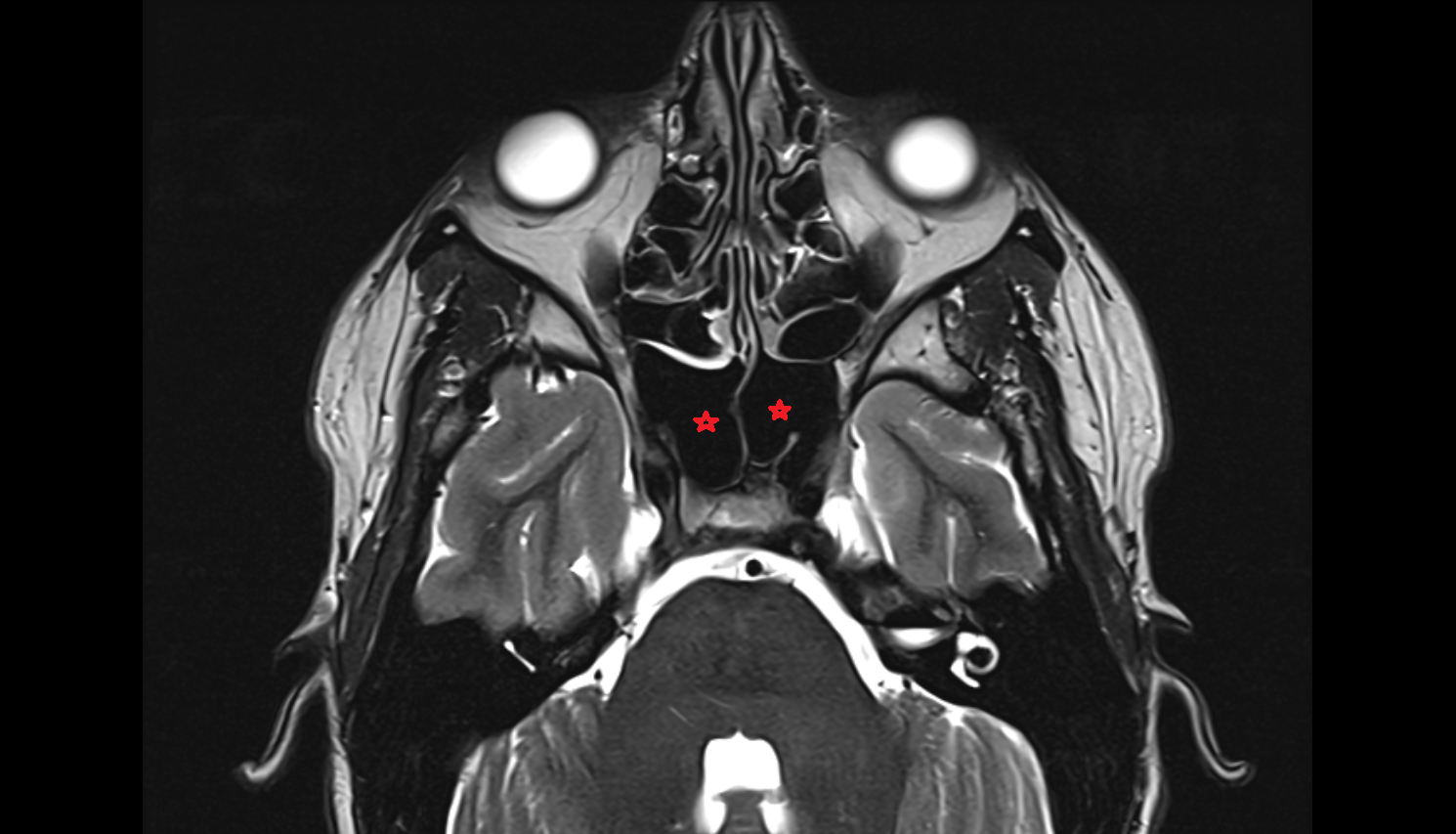 sphenoid sinus cells axial mri image-img-00000-00000