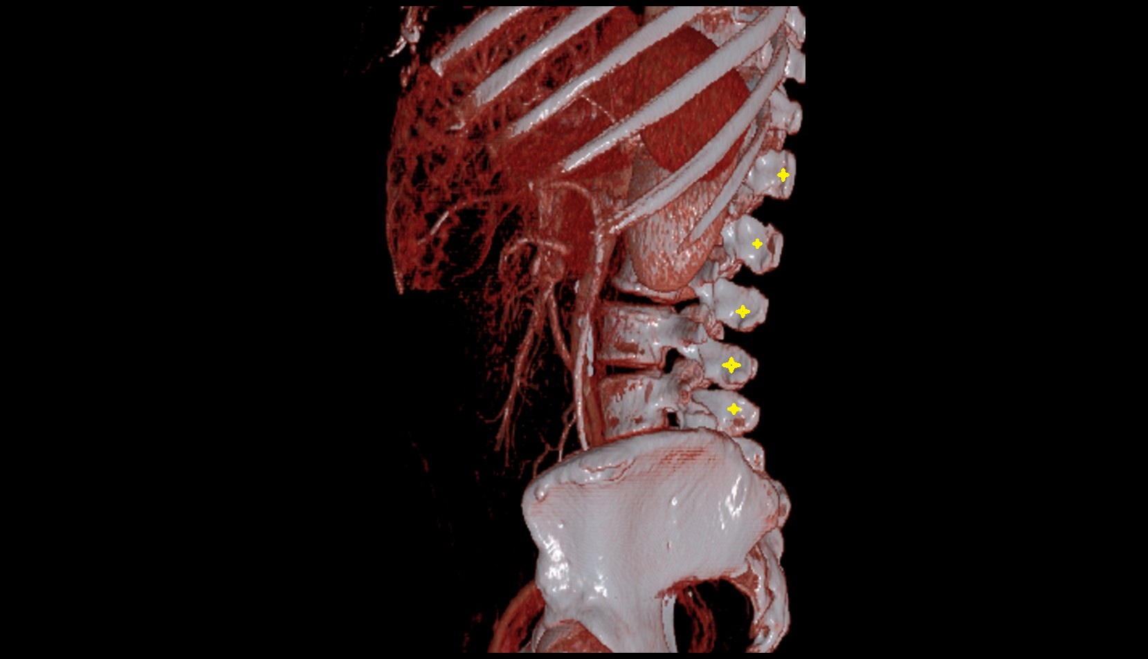 spinous process of vertebrae ct 3d image