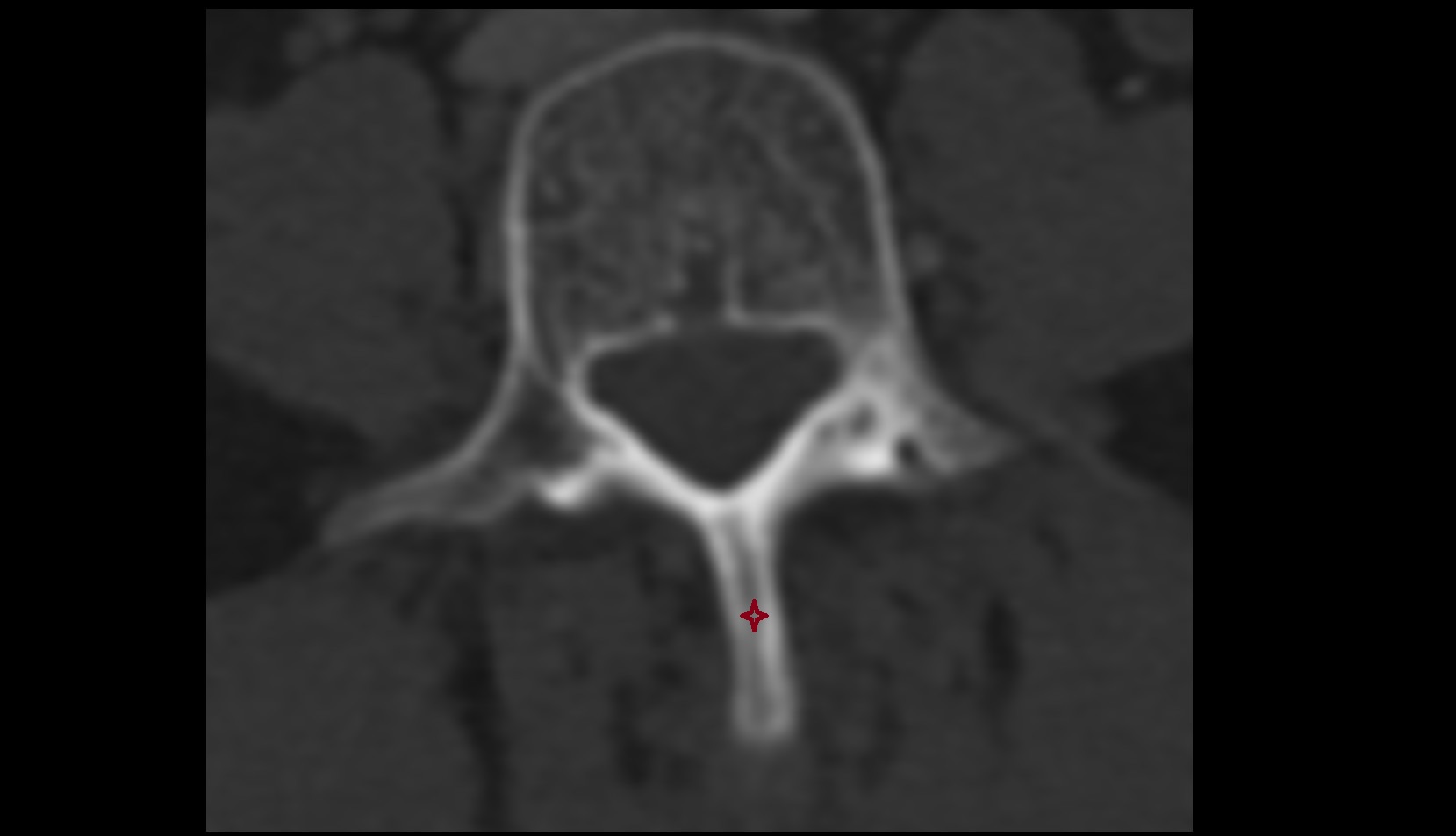 spinous process of vertebrae ct axial image