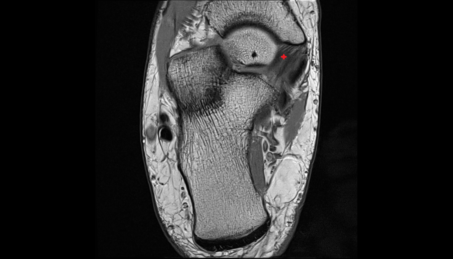 spring ligament complex  axial cross sectional anatomy 3T MRI AI enhanced radiology image-img-00000-00000