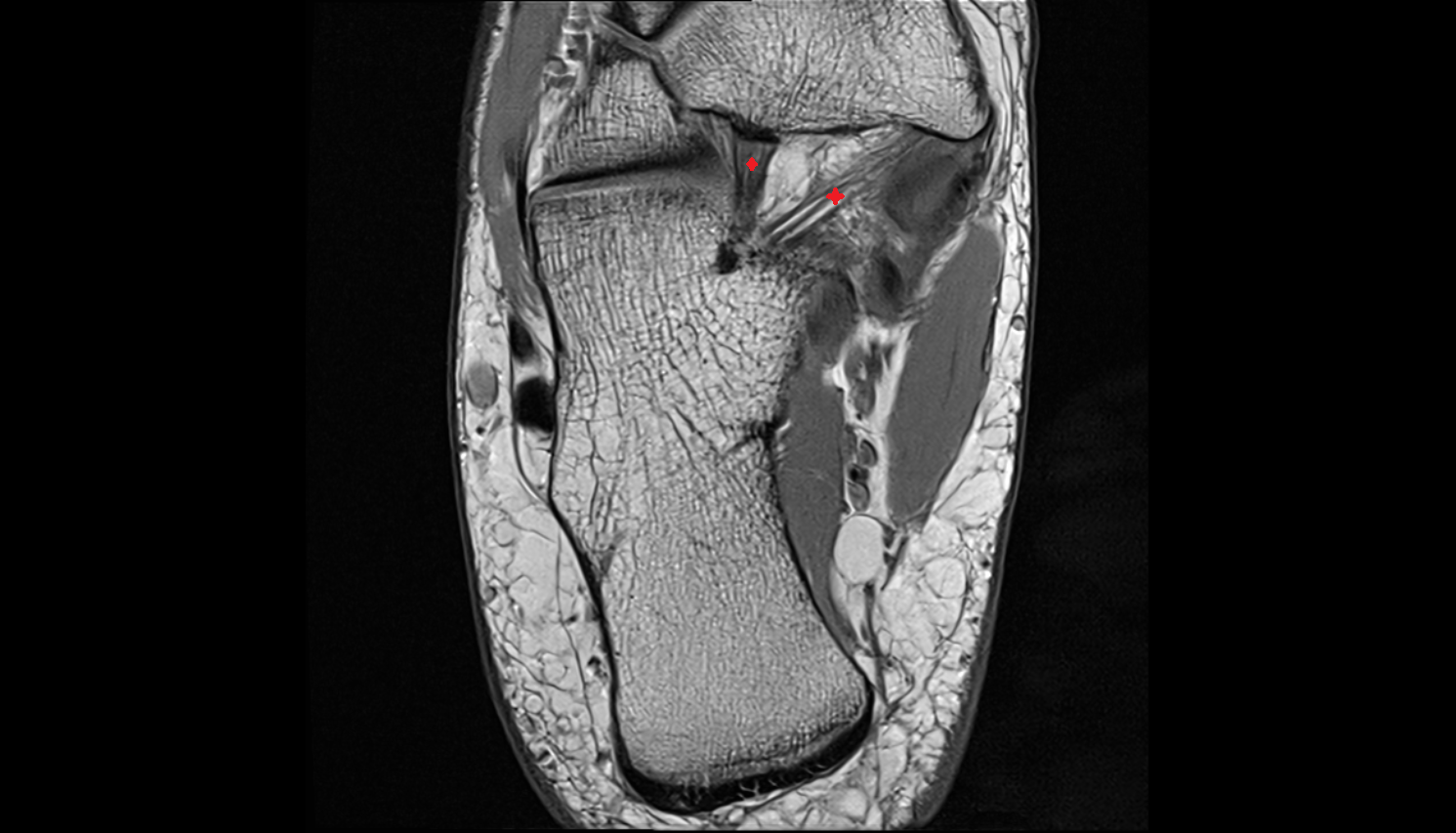 spring ligament complex  axial cross sectional anatomy 3T MRI AI enhanced radiology image-img-00000-00000_00001