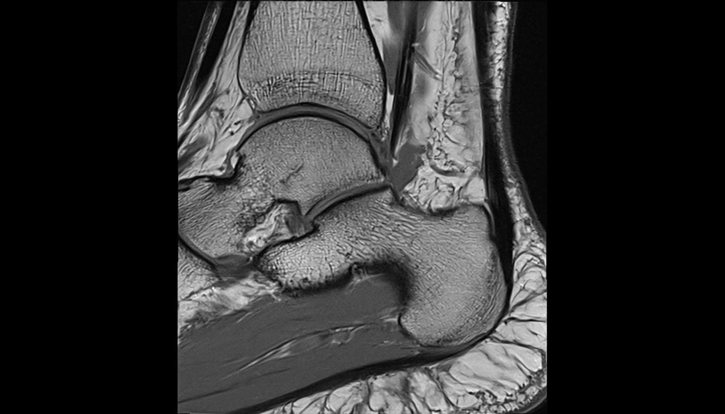 spring ligament complex  sagittal cross sectional anatomy 3T MRI AI enhanced radiology image-img-00000-00000_00001