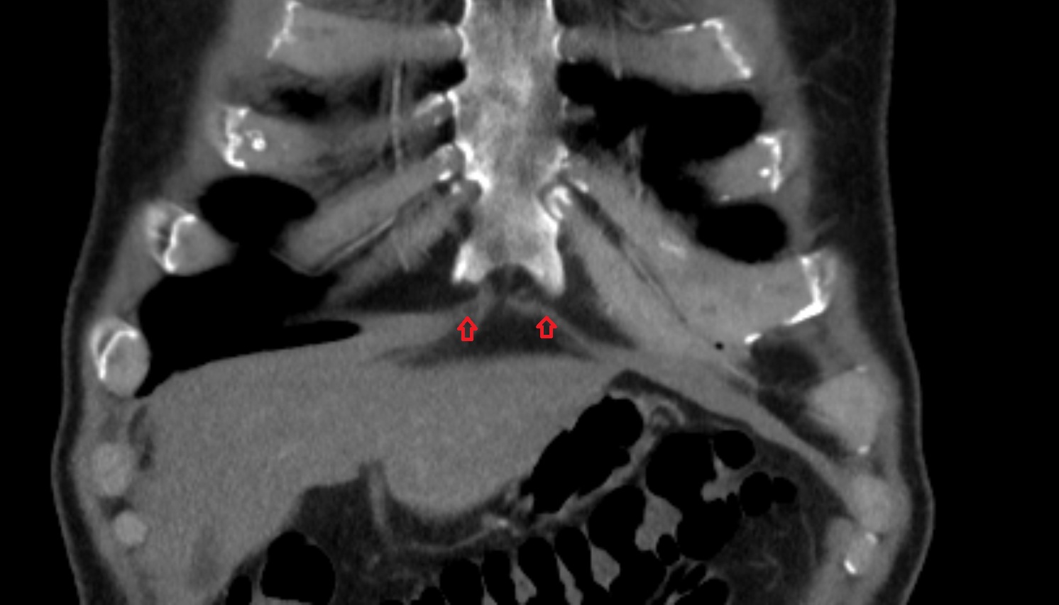 sternal part of diaphragm CT coronal  image -img-00000-00000
