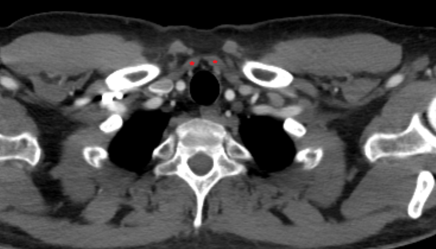 sternohyoid muscle   anatomy CT axial  image -img-00000-00000