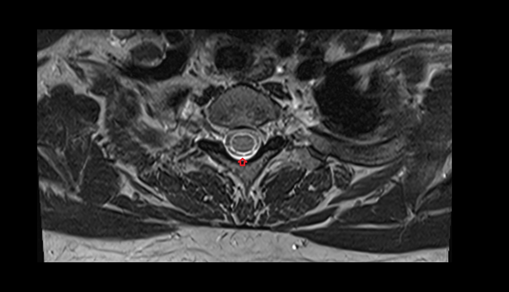 subarachnoid space of spinal cord axial c spine  mri