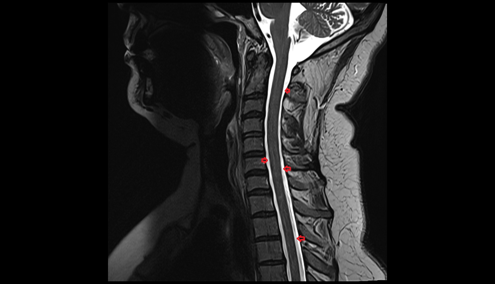 subarachnoid space of spinal cord sag c spine  mri