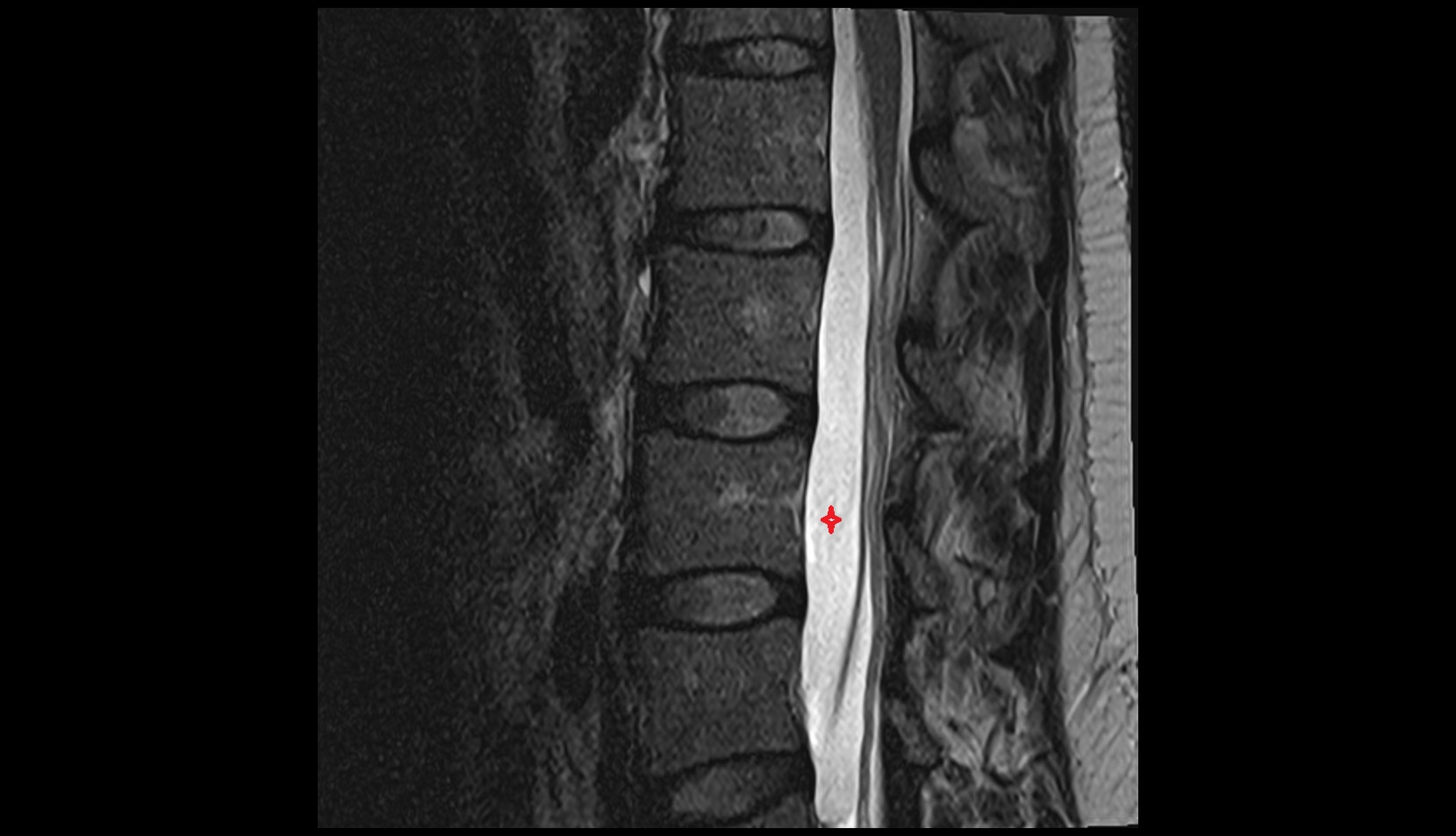 subarachnoid space of spinal cord sag l spine  mri