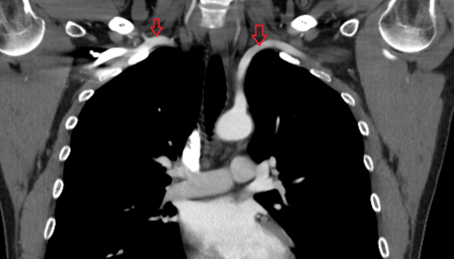 subclavian artery anatomy CT coronal  image -img-00000-00000