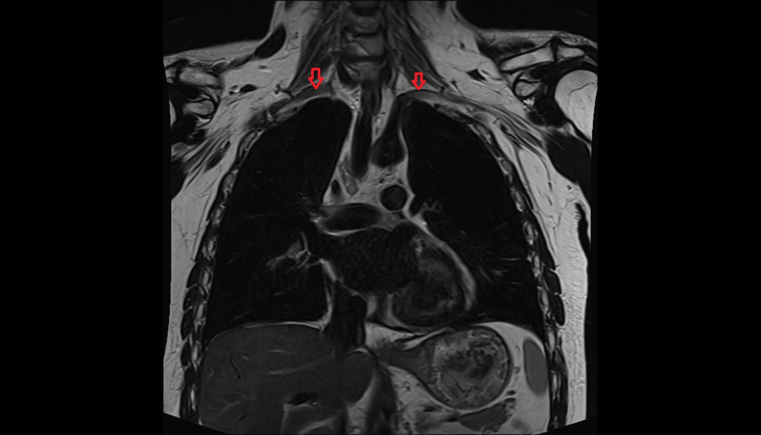 subclavian artery anatomy MRI  coronal  image -img-00000-00000