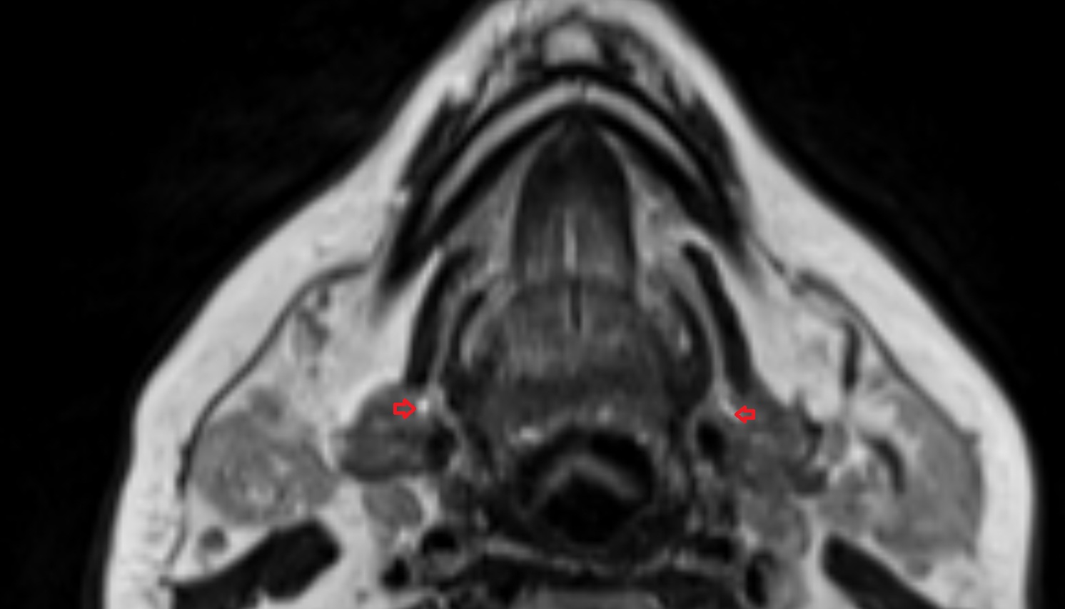submandibular duct  mri axial image -img-00000-00000