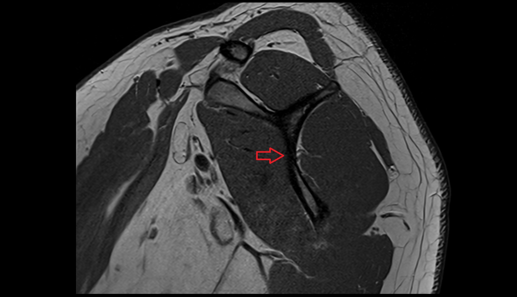 subscapular fossa mri image