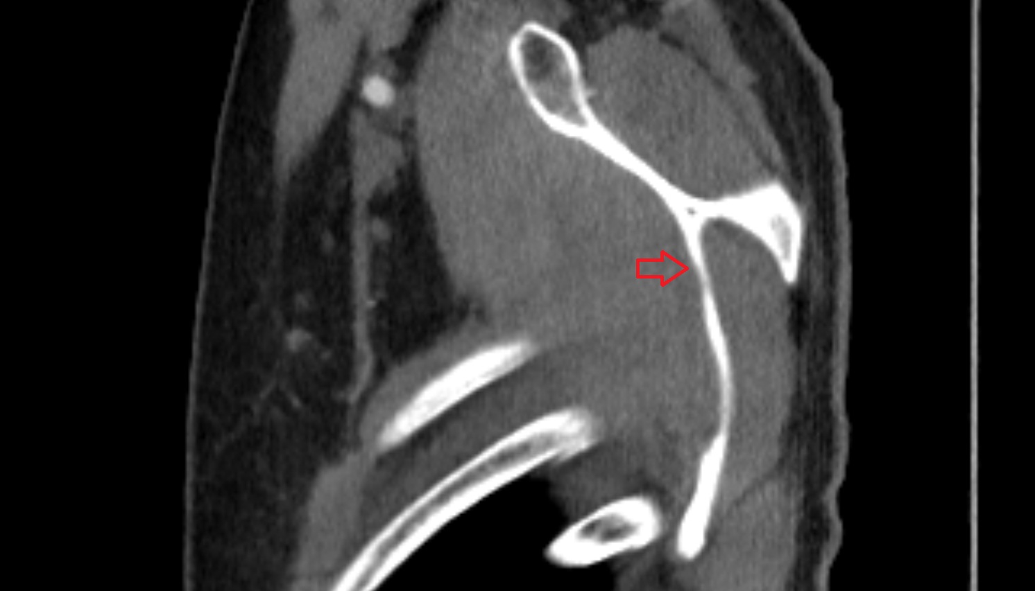 subscapular fossa of scapula CT sag  image -img-00000-00000