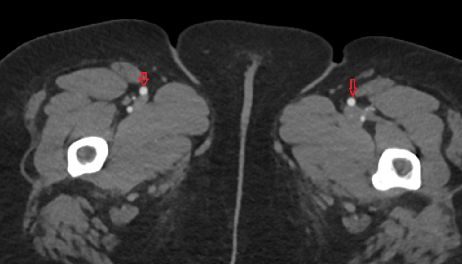 superficial femoral artery  CT axial image  MRI  axial  anatomy  image-img-00000-00000