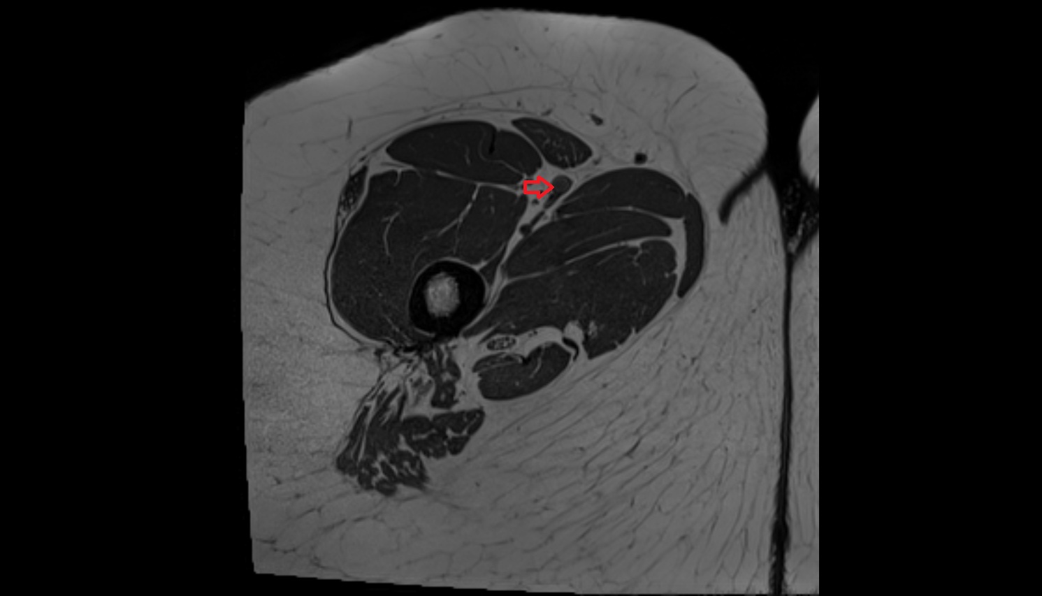 superficial femoral artery  MRI axial image  MRI  axial  anatomy  image-img-00000-00000