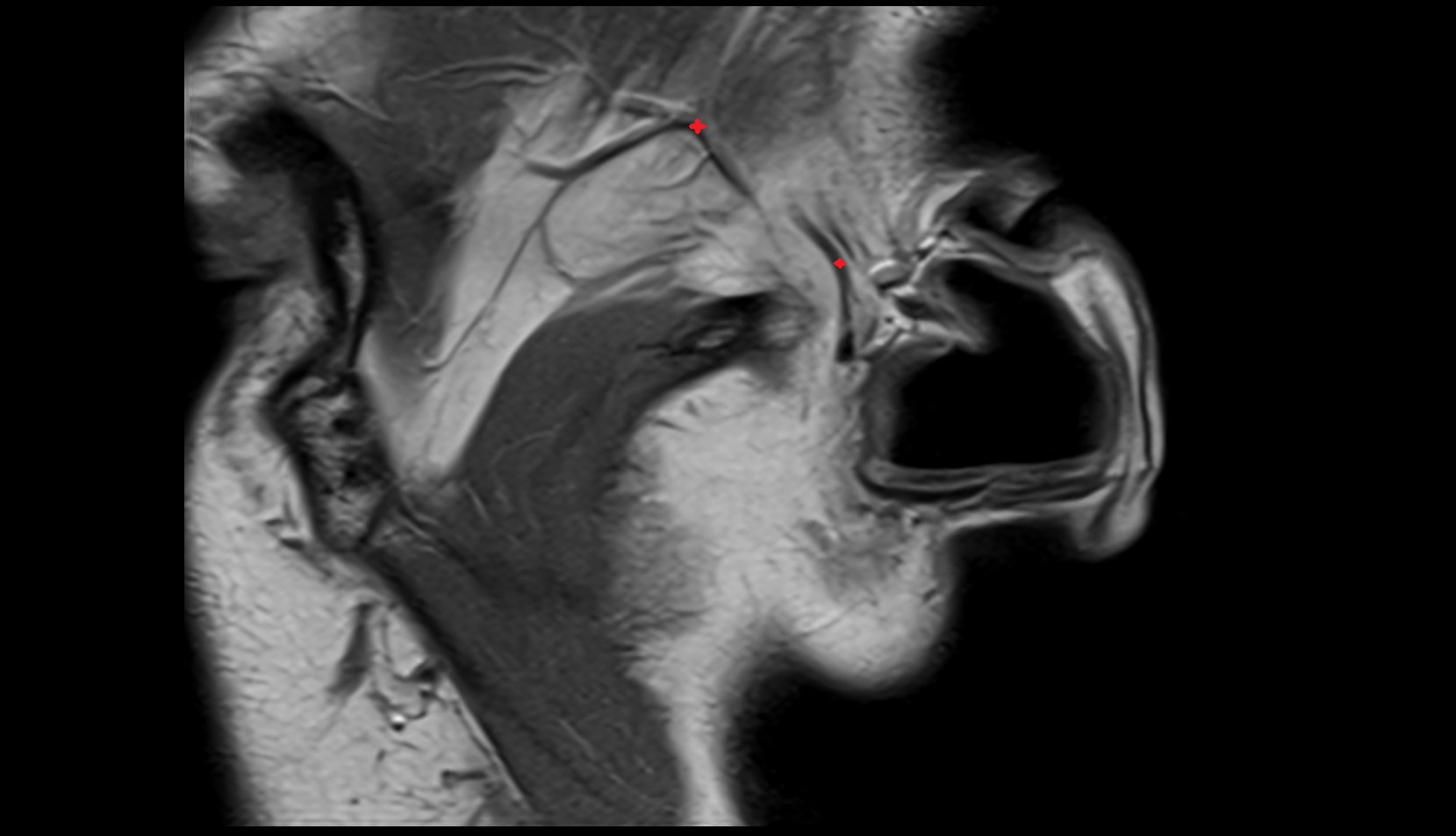 superficial temporal vein MRI image