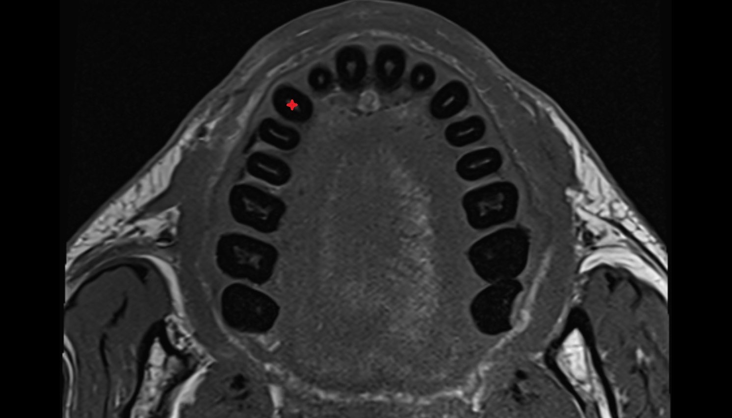 superior canine tooth mri axial  image -img-00000-00000