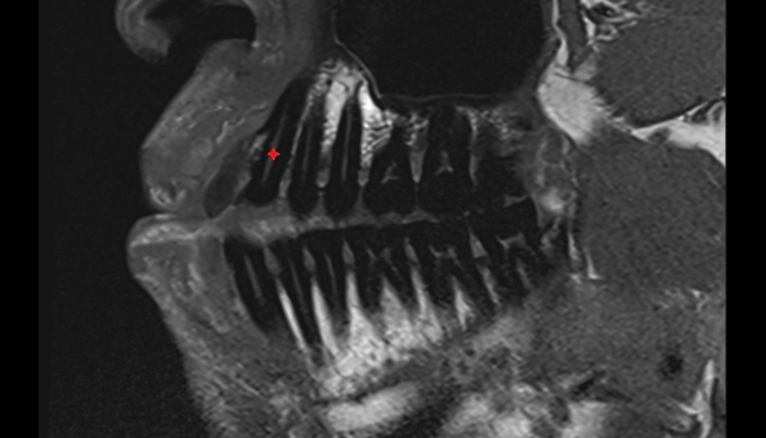 superior canine tooth mri sag  image -img-00000-00000