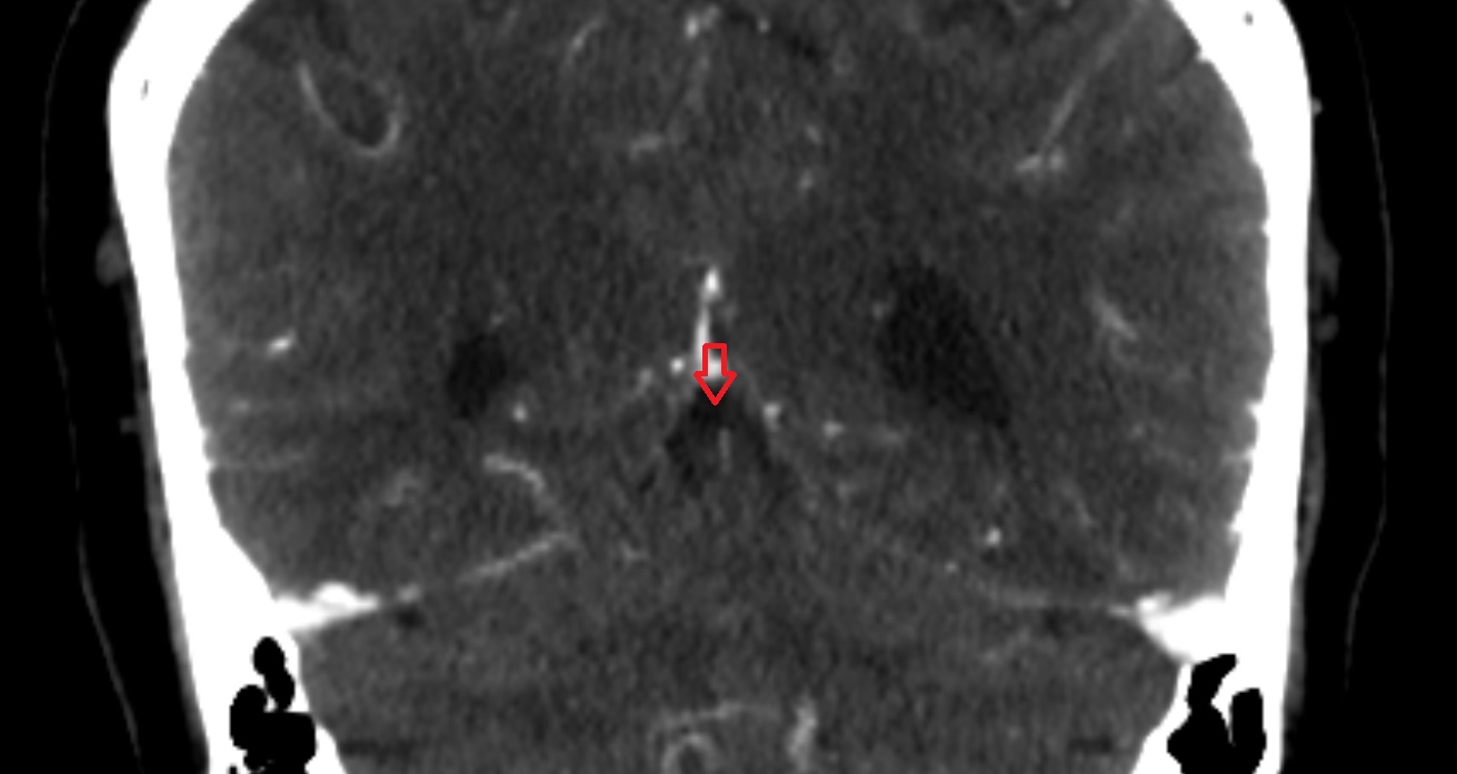 superior cerebellar cistern  CT coronal anatomy image -img-00001-00001