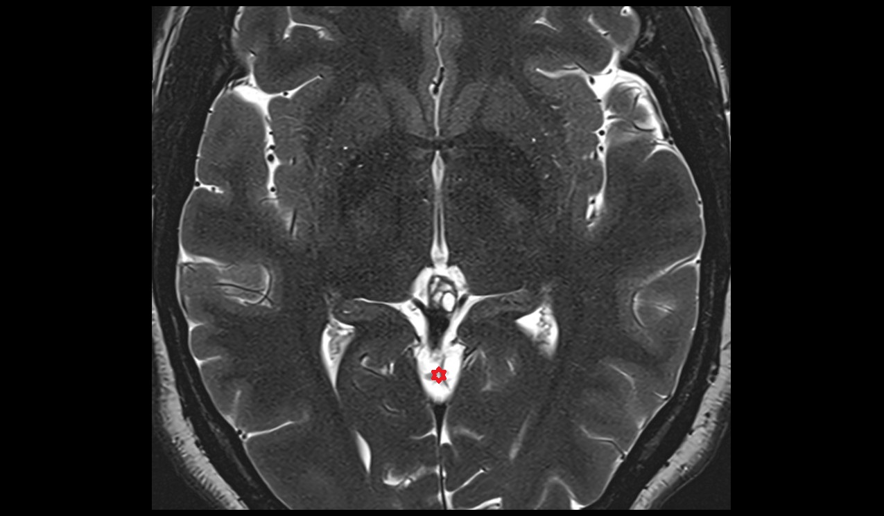 superior cerebellar cistern  mri 3t axial image