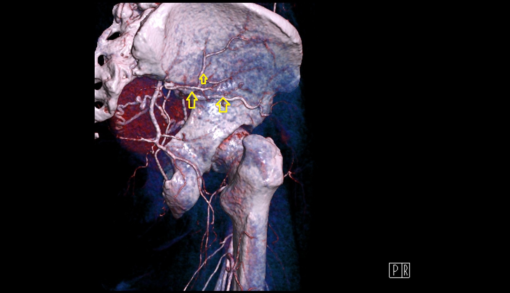 superior gluteal artery CT 3D VRT anatomy image