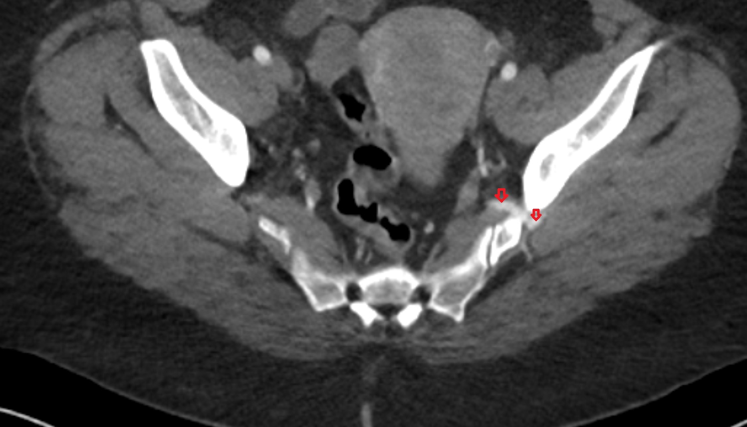 superior gluteal artery  CT  axial  anatomy  image-img-00000-00000