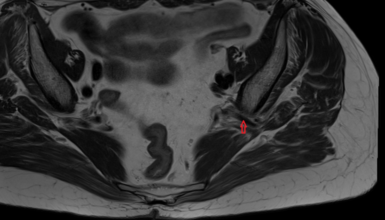 superior gluteal artery  MRI  axial  anatomy  image-img-00000-00000