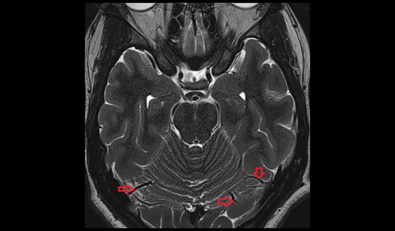 superior hemispheric veins MRI 3T axial  image