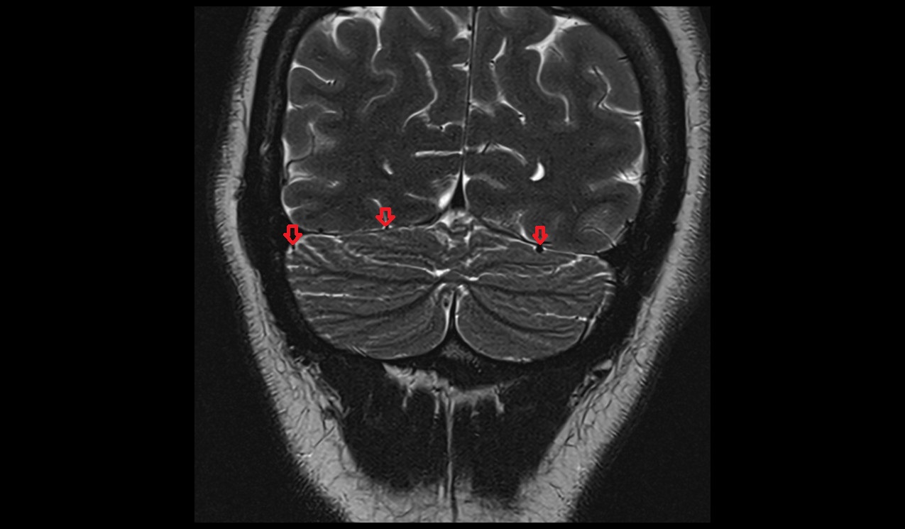 superior hemispheric veins MRI 3T coronal image