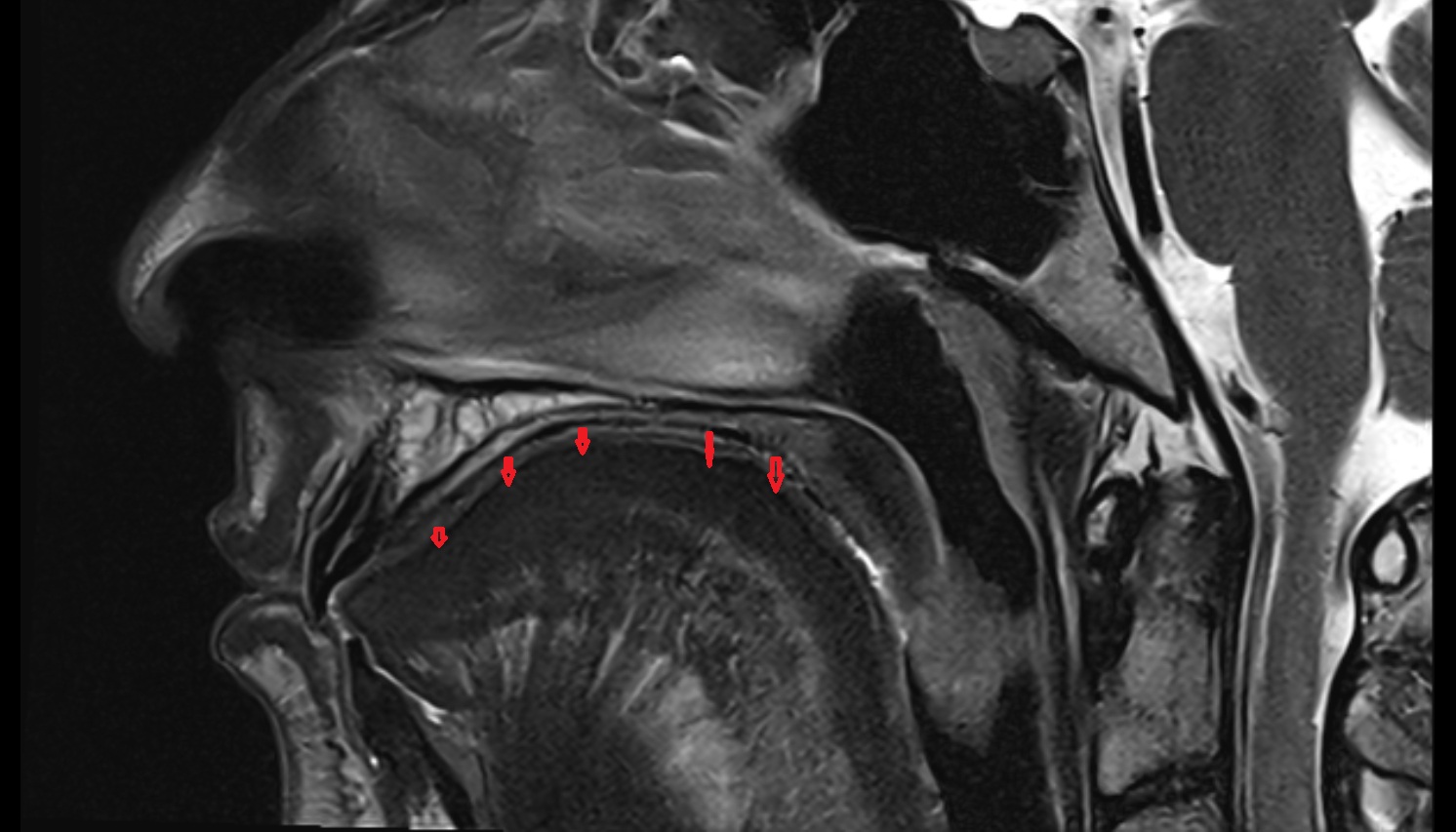 superior longitudinal muscle of tongue MRI IMAGE -img-00000-00000