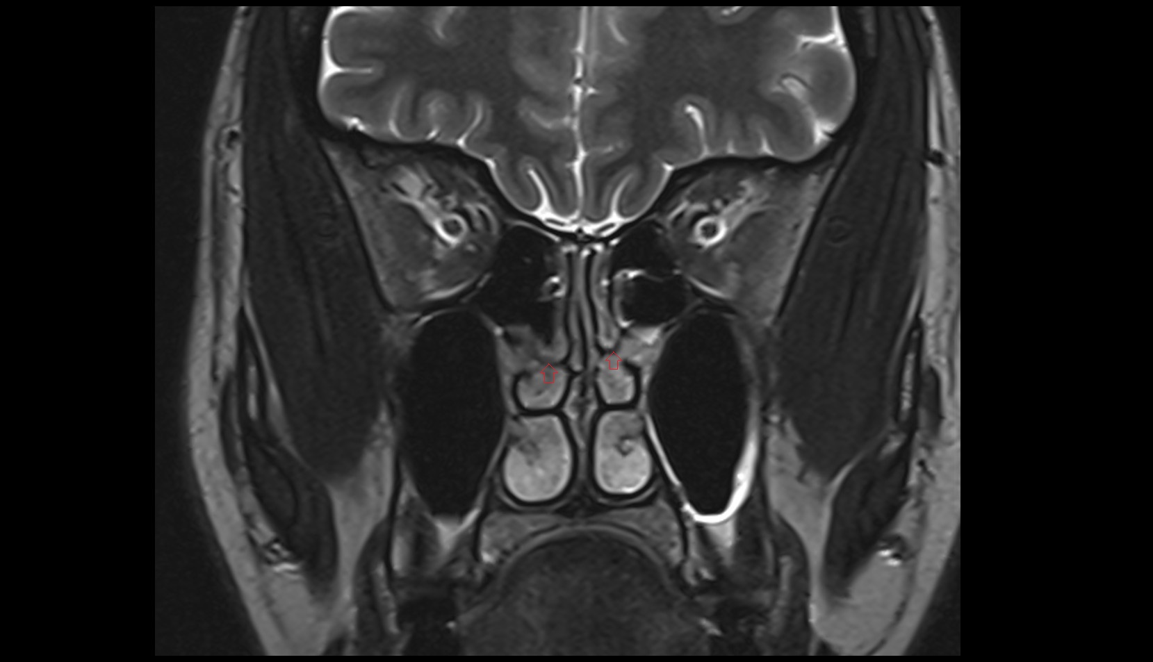 superior nasal meatus mri coronal image