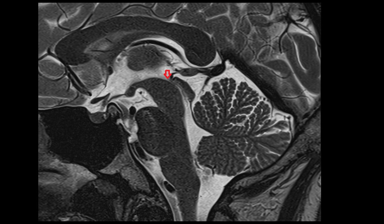 superior opening of the cerebral aqueduct mri 3t sagittal image