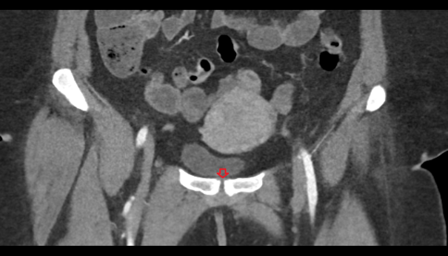 superior pubic ligament  CT coronal  anatomy  image-img-00000-00000