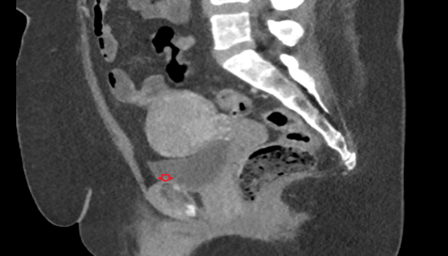 superior pubic ligament  CT sag  anatomy  image-img-00000-00000