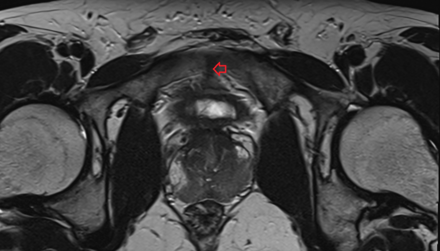 superior pubic ligament  MRI axial  anatomy  image-img-00000-00000