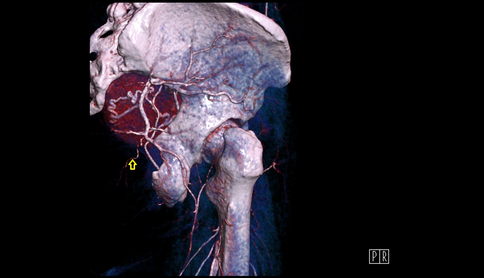 superior rectal artery  CT 3D VRT anatomy image