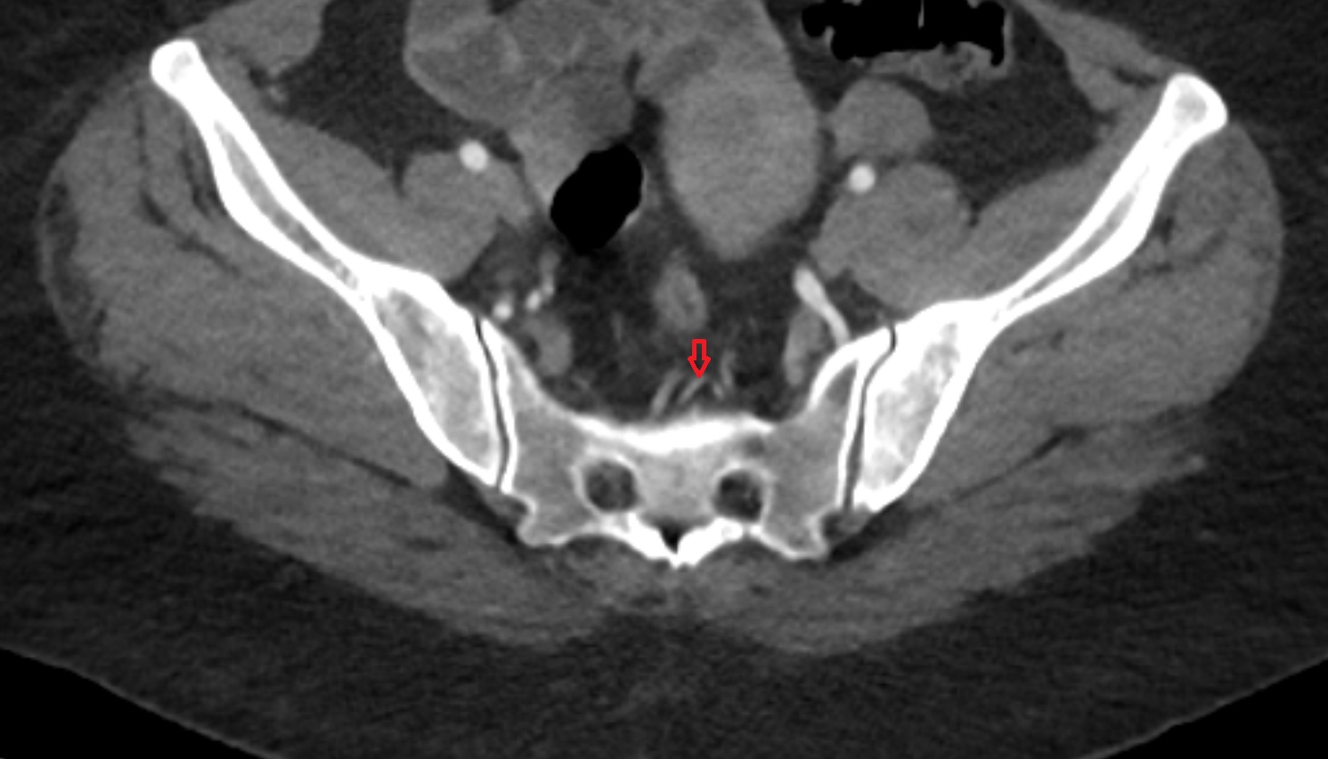 superior rectal artery  CT  axial  anatomy  image-img-00000-00000