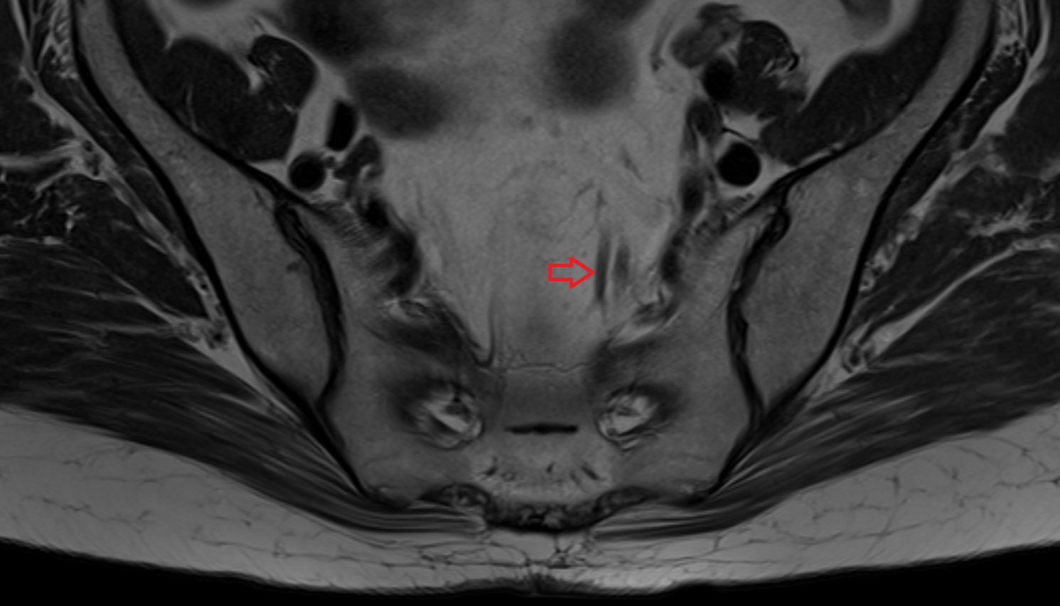 superior rectal artery  MRI axial image  MRI  axial  anatomy  image-img-00000-00000